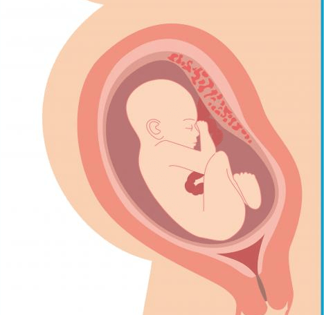 Posterior placenta
